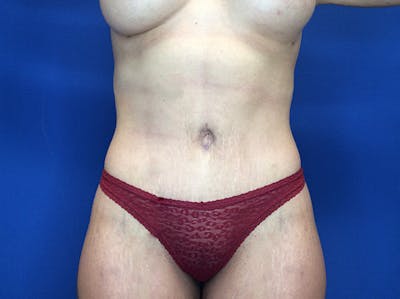 Liposuction Before & After Gallery - Patient 147775342 - Image 2