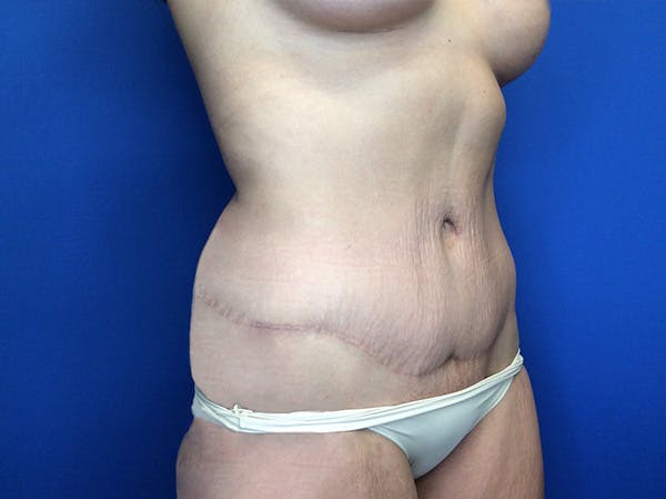 Liposuction Before & After Gallery - Patient 147775342 - Image 3