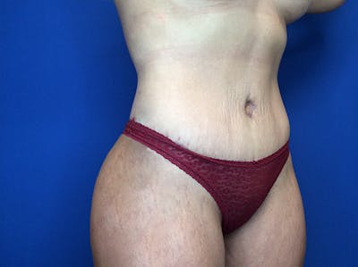 Liposuction Before & After Gallery - Patient 147775342 - Image 4