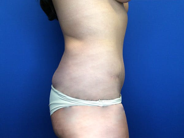 Brazilian Butt Lift Before & After Gallery - Patient 147775349 - Image 7