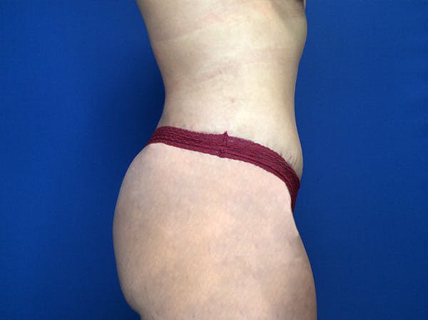 Brazilian Butt Lift Before & After Gallery - Patient 147775349 - Image 8