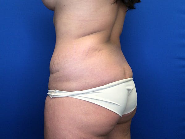 Liposuction Before & After Gallery - Patient 147775342 - Image 7
