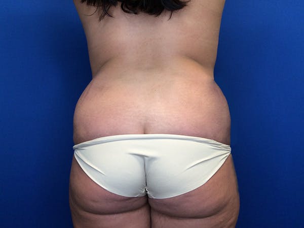 Liposuction Before & After Gallery - Patient 147775342 - Image 9