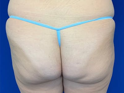 Brazilian Butt Lift Before & After Gallery - Patient 147775502 - Image 1