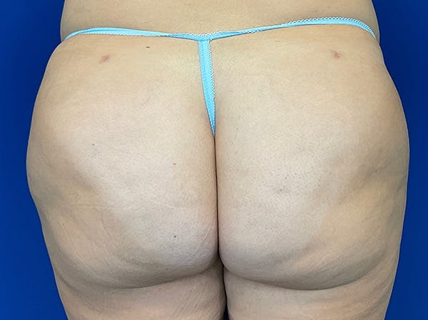 Brazilian Butt Lift Before & After Gallery - Patient 147775502 - Image 2