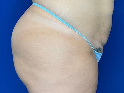 Brazilian Butt Lift Before & After Gallery - Patient 147775502 - Image 4