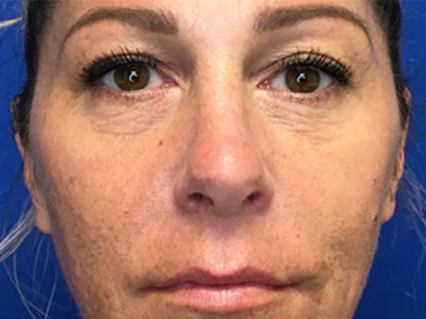 Blepharoplasty Before & After Gallery - Patient 147775844 - Image 1