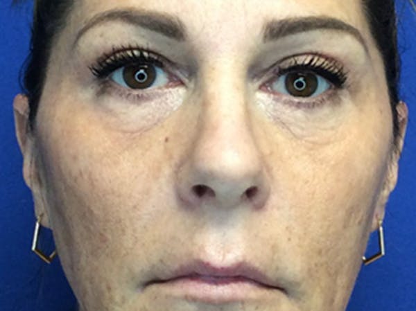 Blepharoplasty Before & After Gallery - Patient 147775844 - Image 2