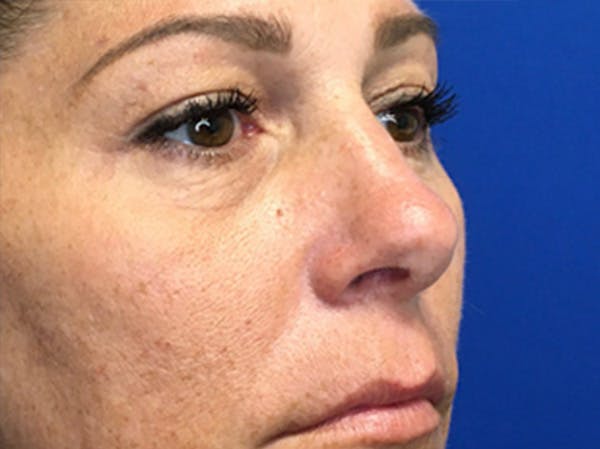 Blepharoplasty Before & After Gallery - Patient 147775844 - Image 3