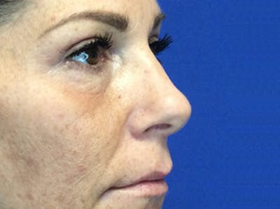 Blepharoplasty Before & After Gallery - Patient 147775844 - Image 4