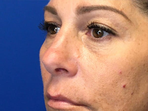 Blepharoplasty Before & After Gallery - Patient 147775844 - Image 5