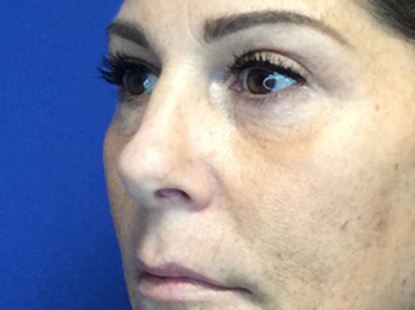 Blepharoplasty Before & After Gallery - Patient 147775844 - Image 6