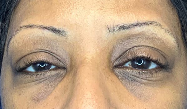 Blepharoplasty Before & After Gallery - Patient 148447555 - Image 1