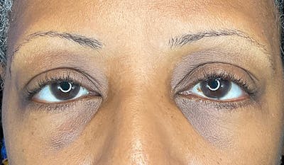 Blepharoplasty Before & After Gallery - Patient 148447555 - Image 2