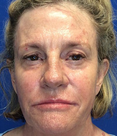 Face Lift Before & After Gallery - Patient 148757438 - Image 1