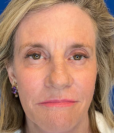 Face Lift Before & After Gallery - Patient 148757438 - Image 4
