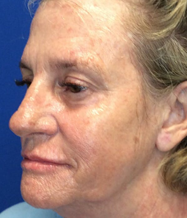 Laser Skin Resurfacing Before & After Gallery - Patient 148757437 - Image 3