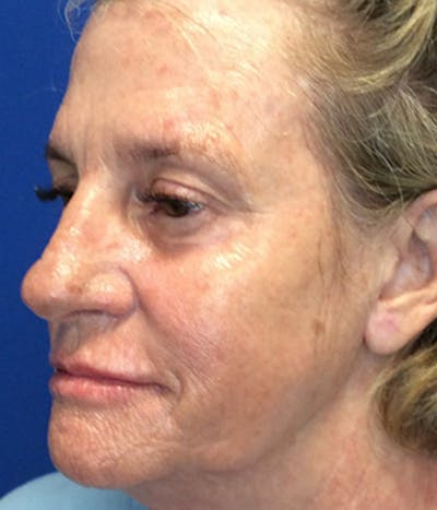 Face Lift Before & After Gallery - Patient 148757438 - Image 1
