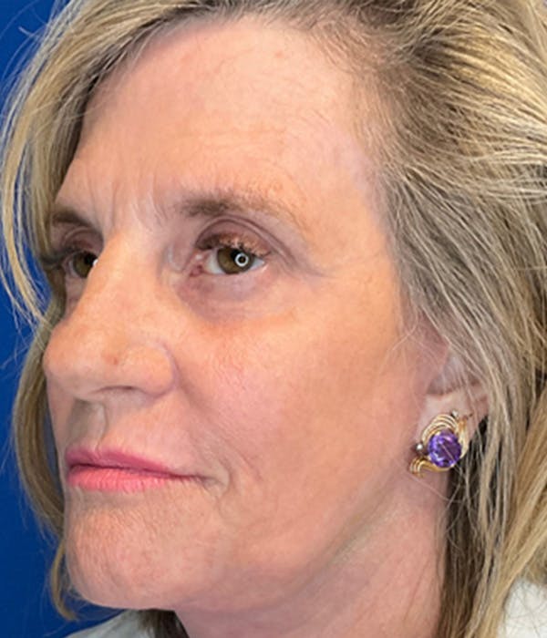 Face Lift Before & After Gallery - Patient 148757438 - Image 2