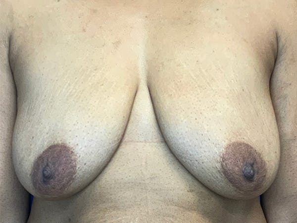 Breast Augmentation Before & After Gallery - Patient 144562395 - Image 1