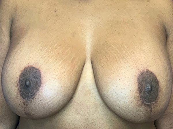 Breast Augmentation Before & After Gallery - Patient 144562395 - Image 2