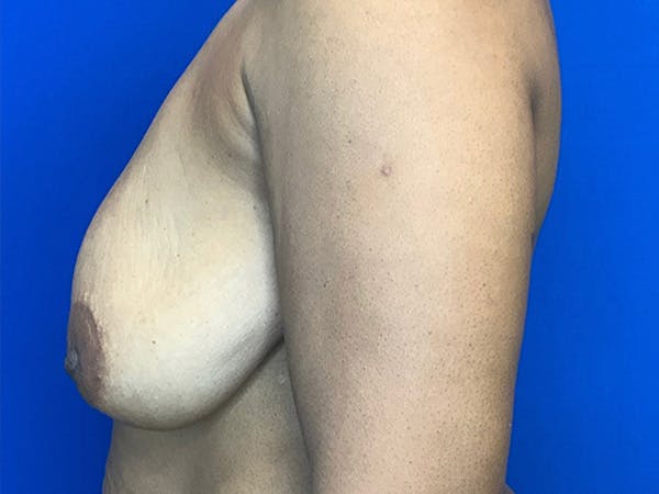 Breast Augmentation Before & After Gallery - Patient 144562395 - Image 3