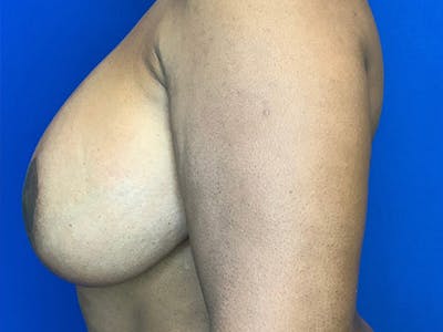 Breast Augmentation Before & After Gallery - Patient 144562395 - Image 4
