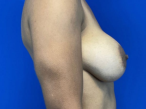 Breast Augmentation Before & After Gallery - Patient 144562378 - Image 4
