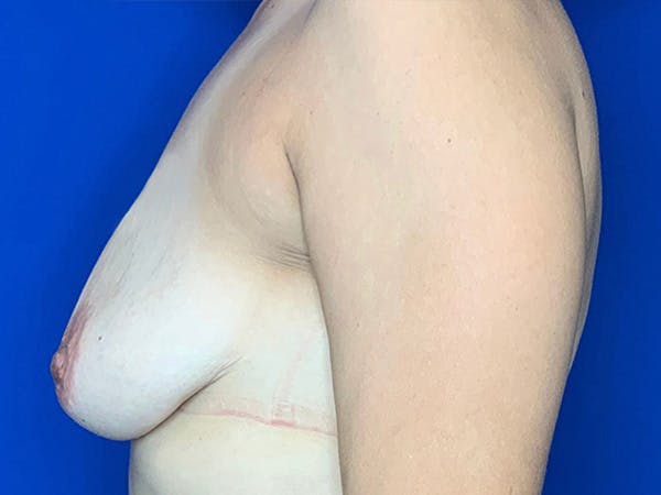 Breast Augmentation Before & After Gallery - Patient 144562357 - Image 3