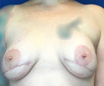 Breast DIEP Flap Reconstruction Before & After Gallery - Patient 4715875 - Image 2