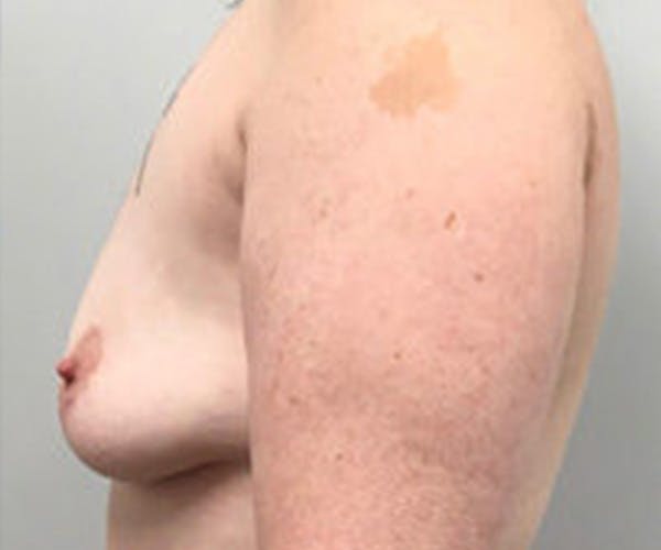 Breast DIEP Flap Reconstruction Before & After Gallery - Patient 4715875 - Image 3