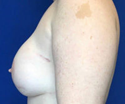Breast DIEP Flap Reconstruction Before & After Gallery - Patient 4715875 - Image 4