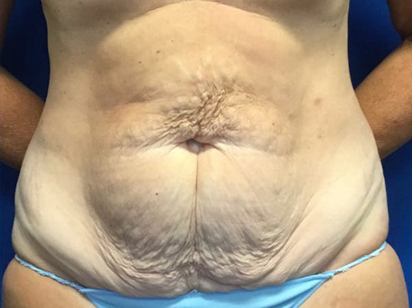 Liposuction Before & After Gallery - Patient 148163705 - Image 1