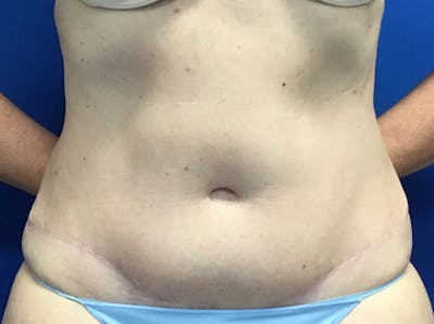 Liposuction Before & After Gallery - Patient 148163705 - Image 2