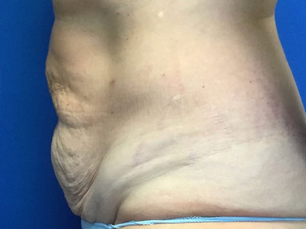 Liposuction Before & After Gallery - Patient 148163705 - Image 3