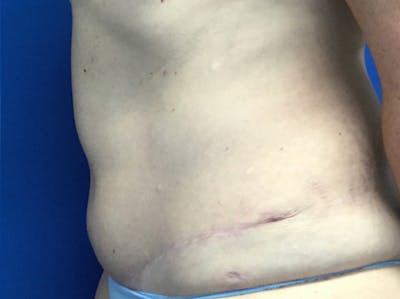 Liposuction Before & After Gallery - Patient 148163705 - Image 4