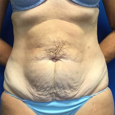 Tummy Tuck (Abdominoplasty) Before & After Gallery - Patient 148163706 - Image 1