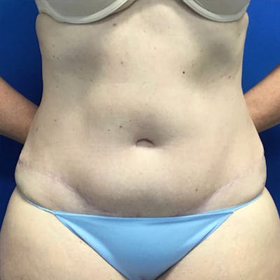 Tummy Tuck (Abdominoplasty) Before & After Gallery - Patient 148163706 - Image 2