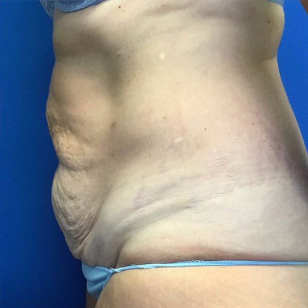 Tummy Tuck (Abdominoplasty) Before & After Gallery - Patient 148163706 - Image 3