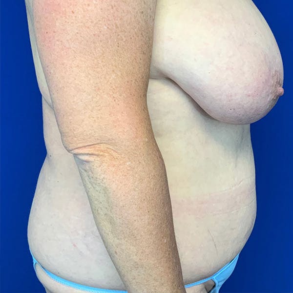 Tummy Tuck (Abdominoplasty) Before & After Gallery - Patient 144562382 - Image 3