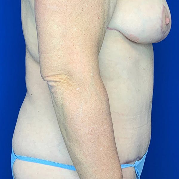 Tummy Tuck (Abdominoplasty) Before & After Gallery - Patient 144562382 - Image 4