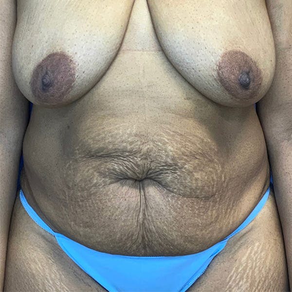 Tummy Tuck (Abdominoplasty) Before & After Gallery - Patient 144562394 - Image 1