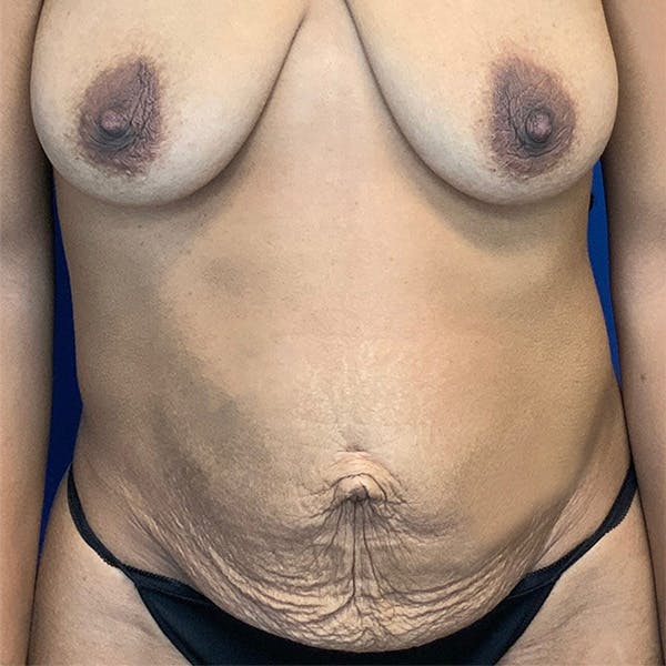 Tummy Tuck (Abdominoplasty) Before & After Gallery - Patient 144562377 - Image 1