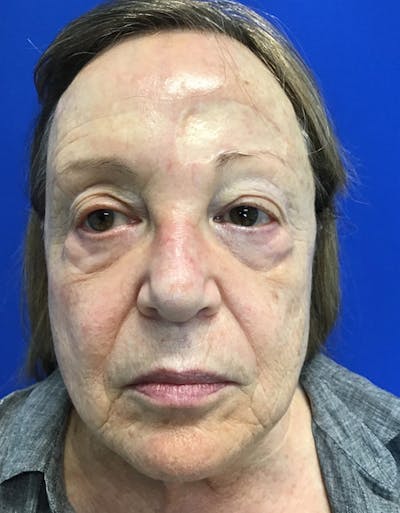 Neck Lift Before & After Gallery - Patient 148758250 - Image 1