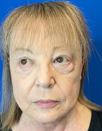 Face Lift Before & After Gallery - Patient 148758249 - Image 2