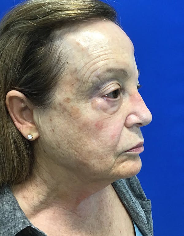 Neck Lift Before & After Gallery - Patient 148758250 - Image 3