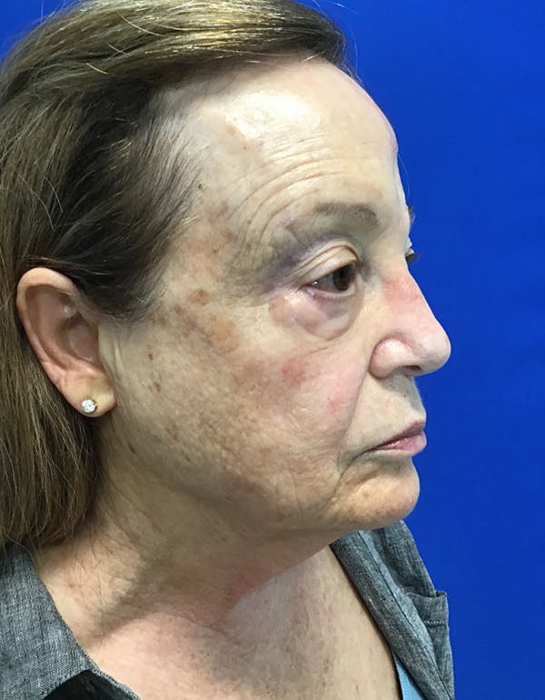 Face Lift Before & After Gallery - Patient 148758249 - Image 5