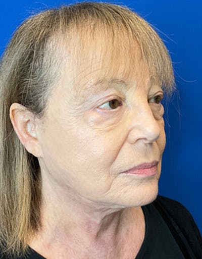 Face Lift Before & After Gallery - Patient 148758249 - Image 6
