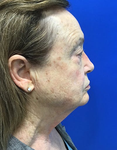 Face Lift Before & After Gallery - Patient 148758249 - Image 1