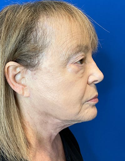 Face Lift Before & After Gallery - Patient 148758249 - Image 2